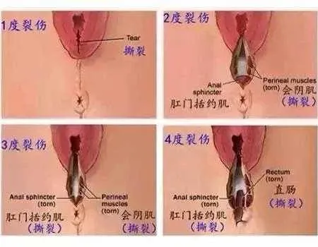 「急產」真的好嗎？揭露醫學上的真相